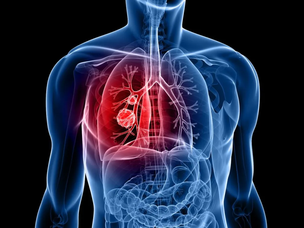 Gran avance de Argentina: se aprobó un tratamiento innovador para el cáncer de pulmón