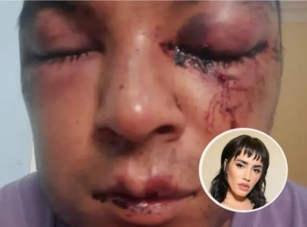 El joven que sufrió un feroz ataque homofóbico recibió un mensaje de Lali: "Lo siento mucho amor, ¡Ayudaremos!”