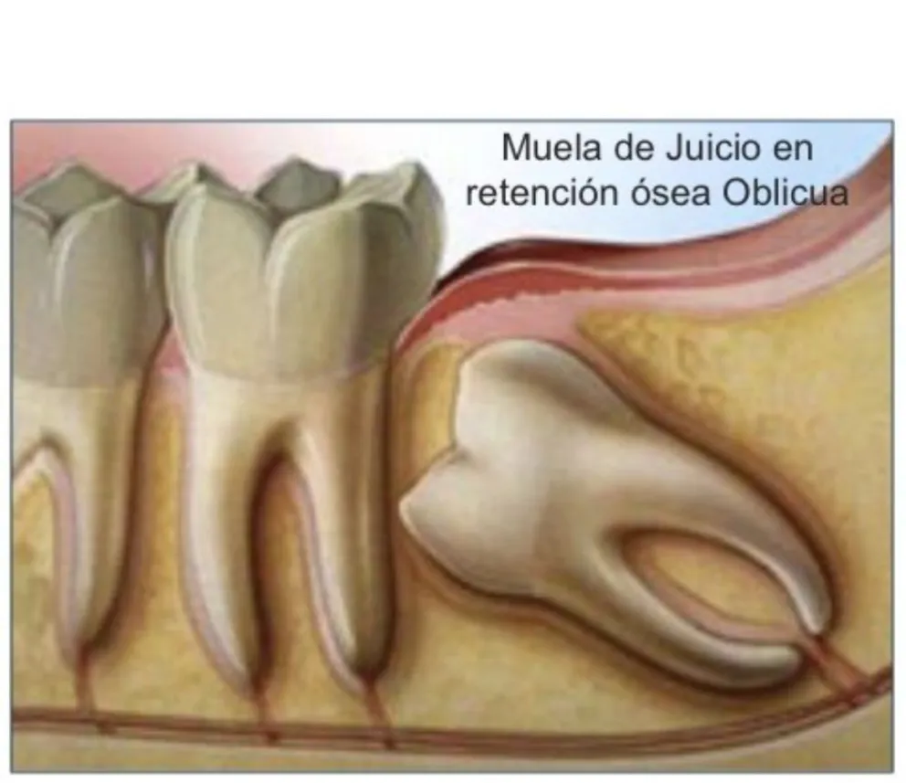 ¿Qué es la Cirugía y Traumatología Bucomaxilofacial?
