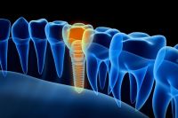 ¿Qué es la Implantología Oral?