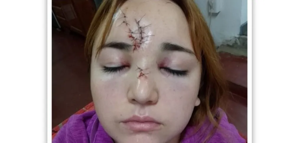 Le destrozaron la cara de un botellazo a una joven en boliche bailable