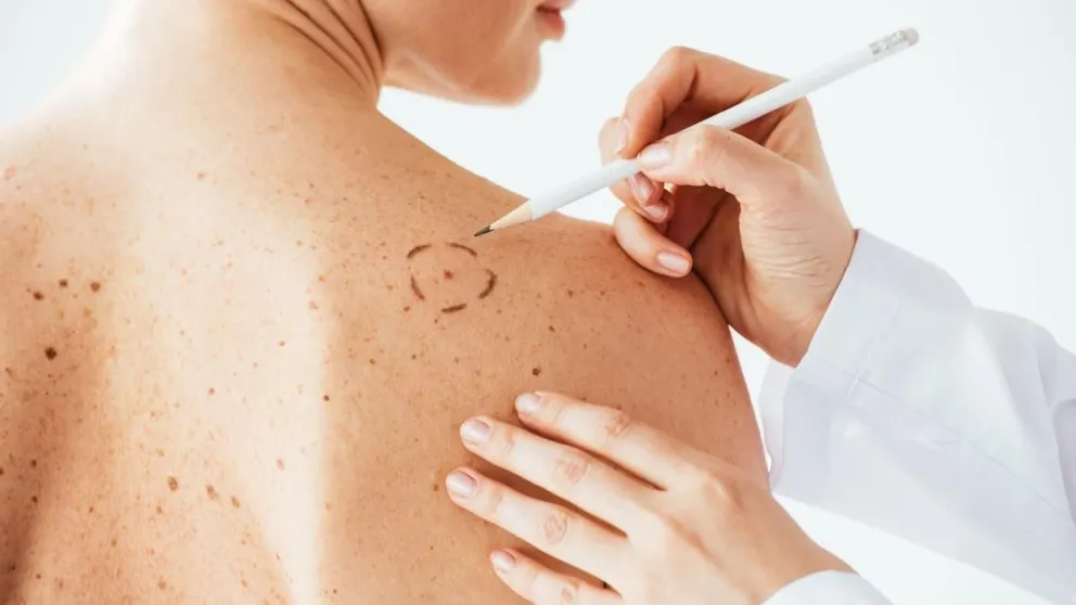 Día Mundial del Cáncer de Piel: claves para cuidarse y la importancia de prevenir la enfermedad
