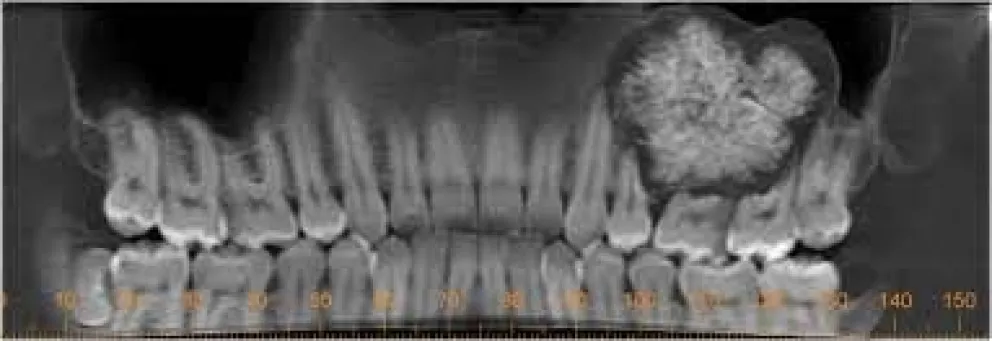 La cirugía y traumatología bucomaxilofacial y su relación con la otorrinolaringología
