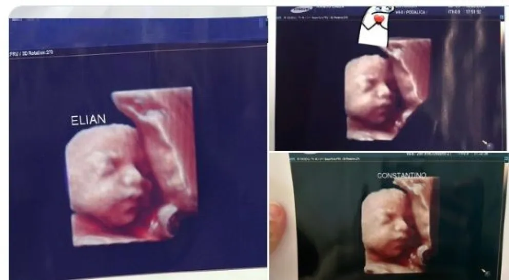 Futuras mamás iban a hacerse una ecografía 5D y a todas les daban la misma foto 